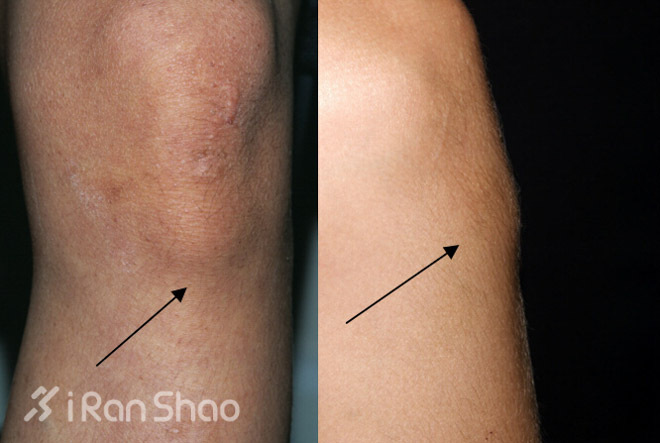 拒绝中箭——膝盖肿了是怎么回事