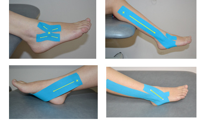 肌内贴不再神秘，贴出你的运动健康（下）