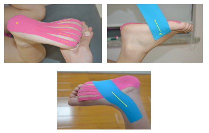 肌内贴不再神秘，贴出你的运动健康（下）