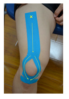 肌内贴不再神秘，贴出你的运动健康（下）