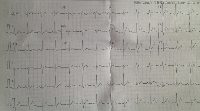 《论跑者的心脏查体》山人阜外医院就诊记录
