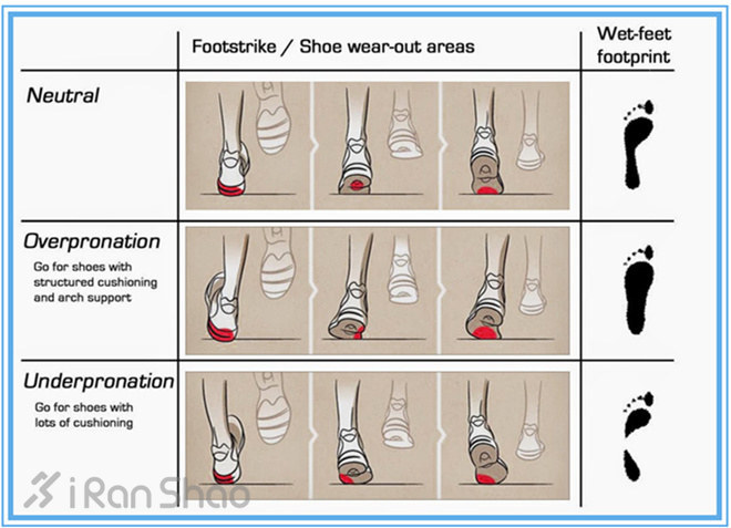 跑者内外翻脚型