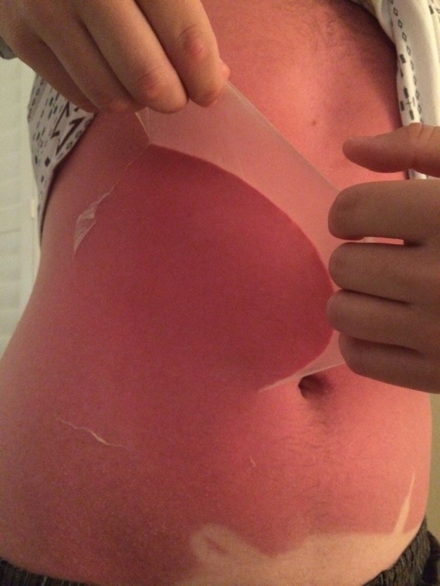 经验｜晒伤后修复妙招推荐