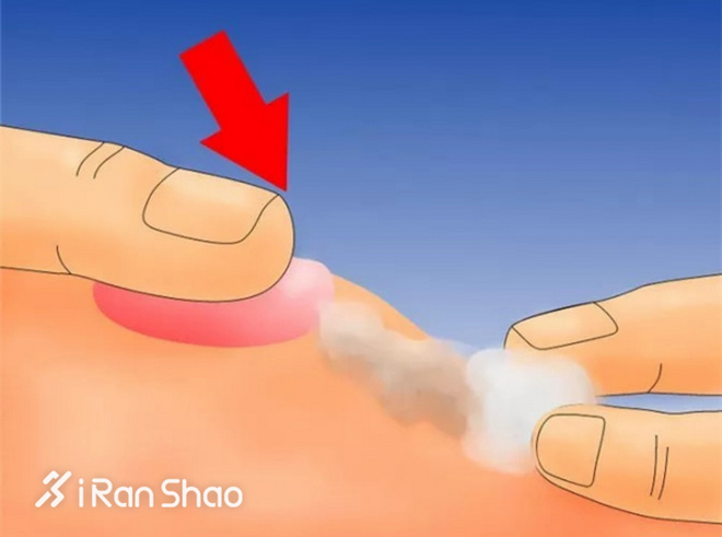 科普 | 水泡不是病，跑起来要人命！水泡原因全解析并附带预防解决办法