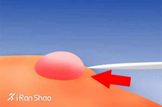 科普 | 水泡不是病，跑起来要人命！水泡原因全解析并附带预防解决办法