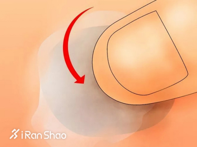 科普 | 水泡不是病，跑起来要人命！水泡原因全解析并附带预防解决办法