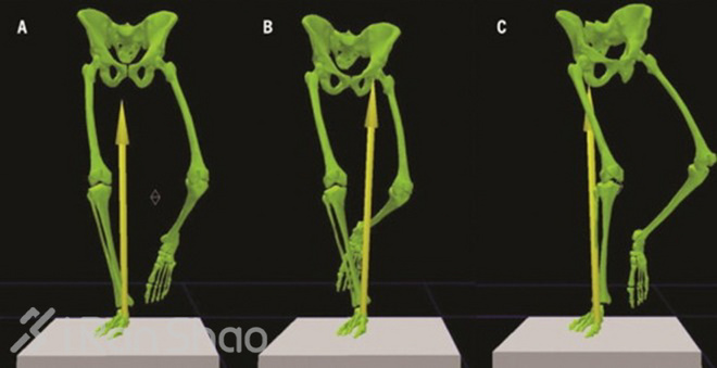 隐藏在膝盖周围的杀手—髂胫束综合征（ITBS）介绍与防治