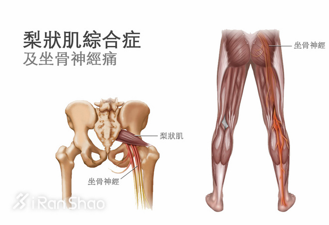 训练 | 跑步后胯部疼痛 请关心一下你的髋关节