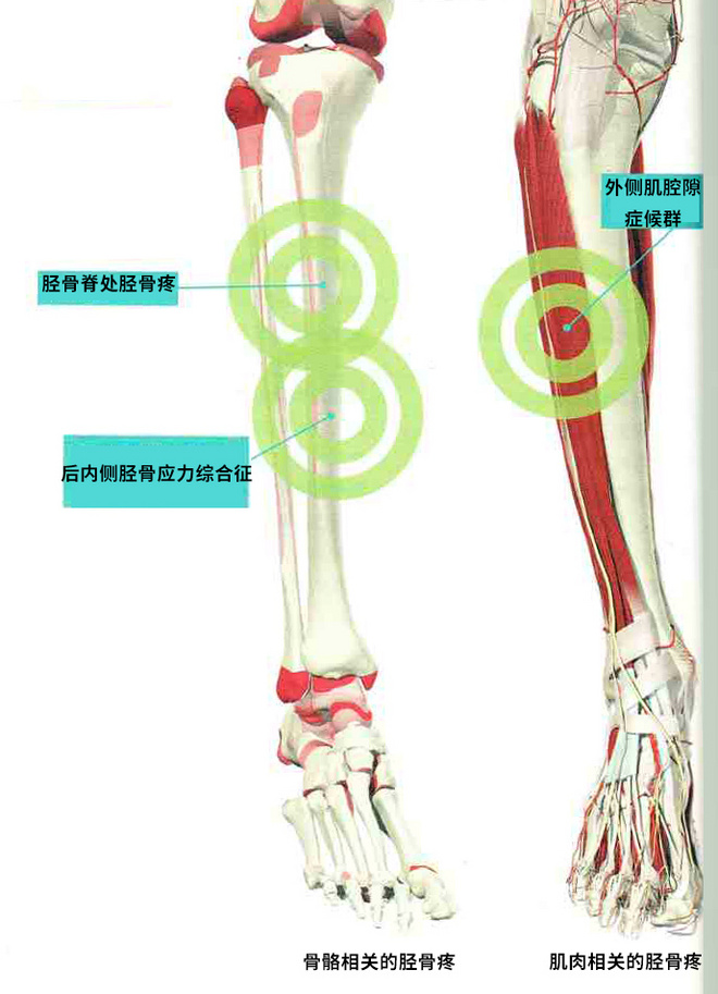 你跑步时小腿前侧疼痛吗？
