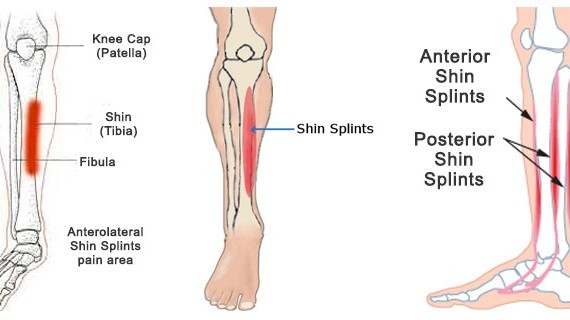 跑步时小腿骨经常性疼痛应该怎么办？