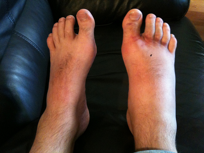 冰敷可以帮助身体恢复？事实或许并非如此