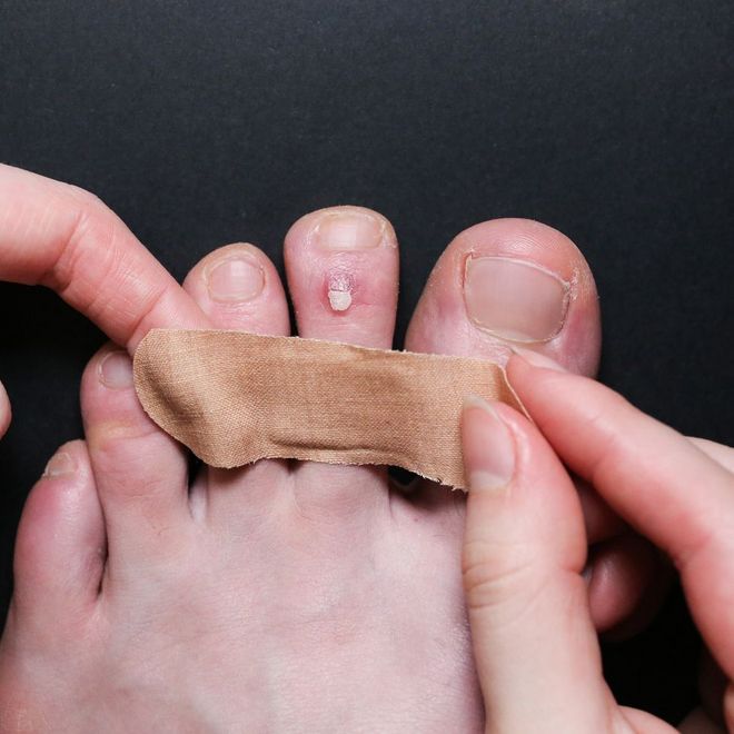 小水泡引发的大烦恼