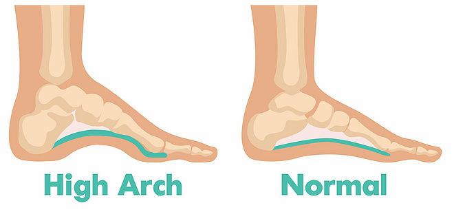 对付足弓疼痛，我们能做的不是只有忍耐